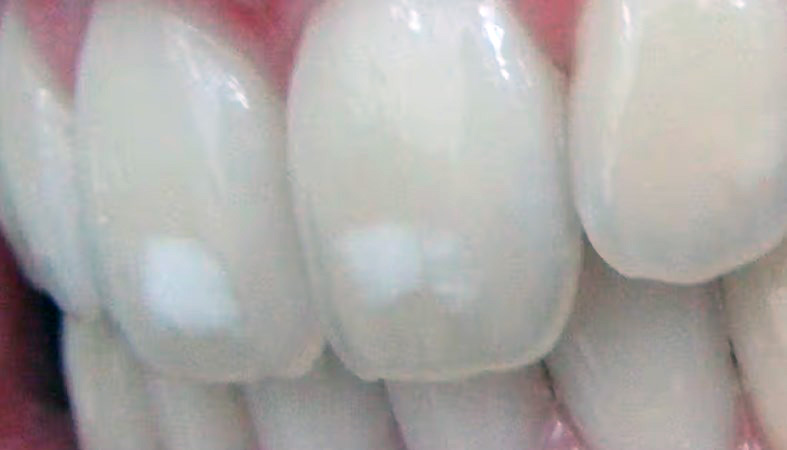 Eleven tips to treat white spots on teeth
